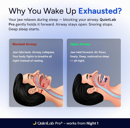 QuietLab Pro Anti-Snoring Mouthpiece